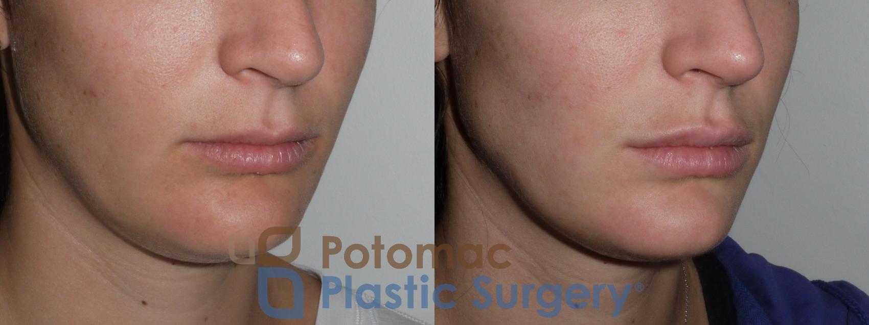 Before & After Lip Augmentation Case 142 Right Oblique View in Washington, DC