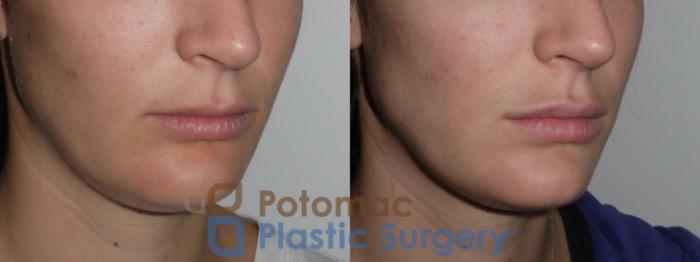 Before & After Dermal Fillers Case 142 Right Oblique View in Washington DC & Arlington , DC