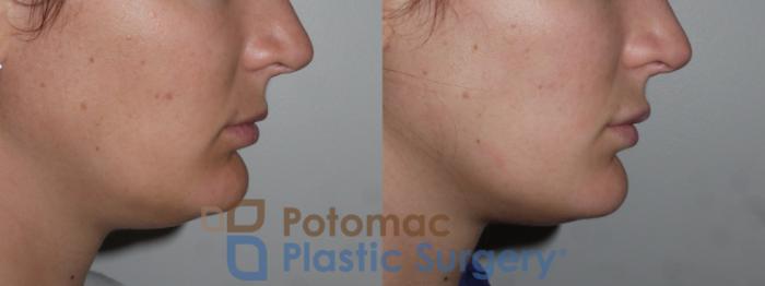 Before & After Lip Augmentation Case 142 Right Side View in Washington, DC
