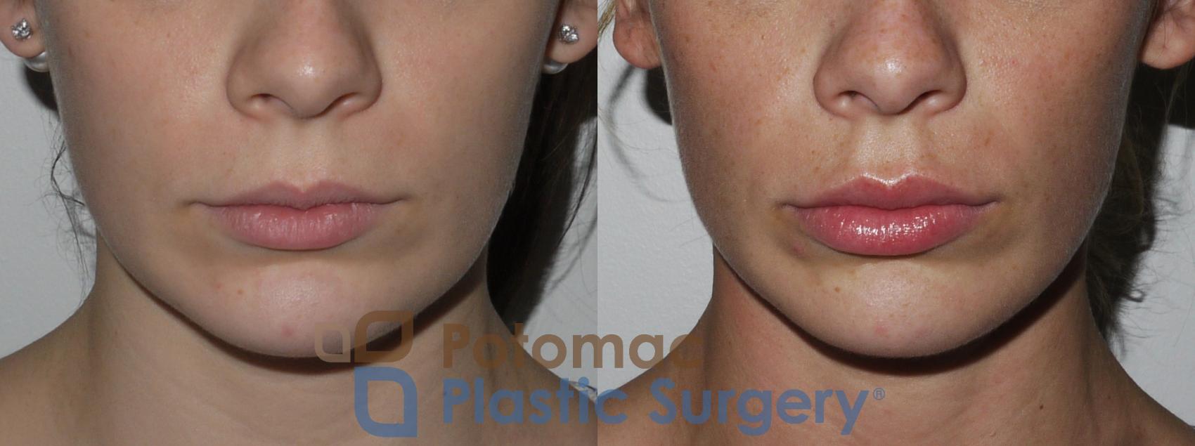 Before & After Dermal Fillers Case 149 Front View in Washington DC & Arlington , DC