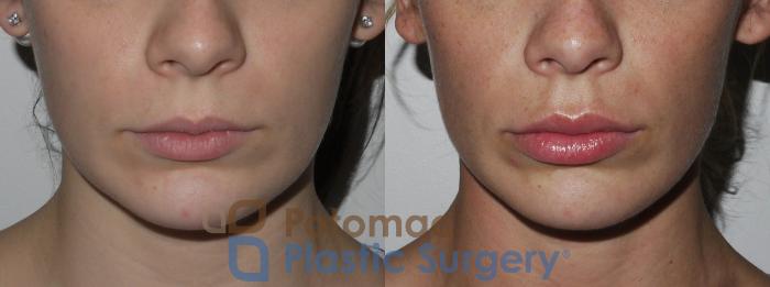 Before & After Dermal Fillers Case 149 Front View in Washington, DC