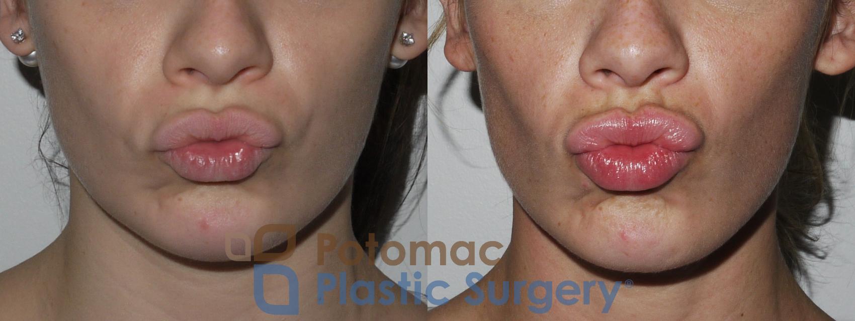 Before & After Lip Augmentation Case 149 Front View #2 View in Washington, DC