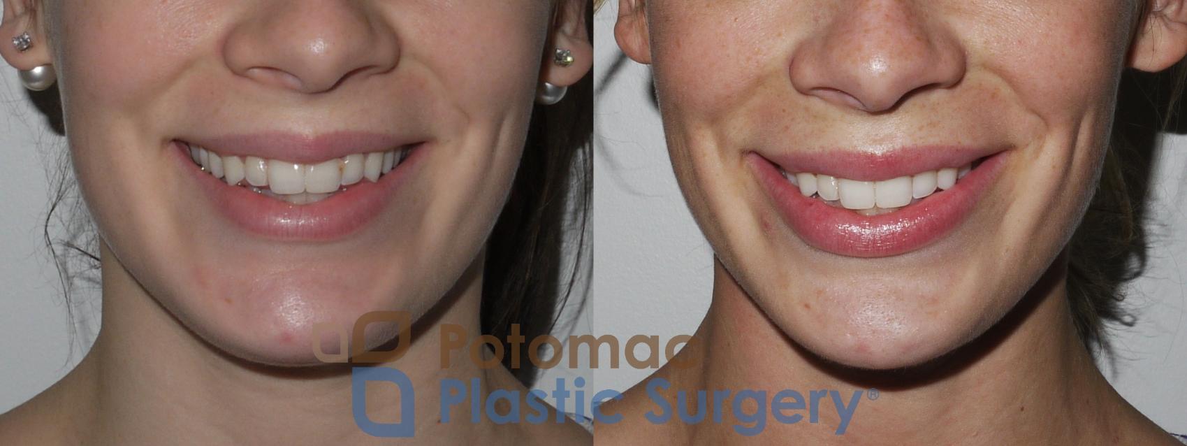 Before & After Lip Augmentation Case 149 Front View #3 View in Washington, DC