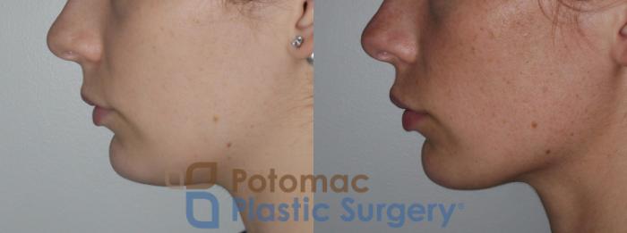 Before & After Lip Augmentation Case 149 Left Side View in Washington, DC