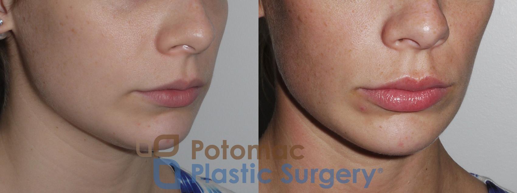 Before & After Lip Augmentation Case 149 Right Oblique View in Washington, DC