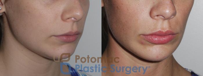Before & After Dermal Fillers Case 149 Right Oblique View in Washington DC & Arlington , DC