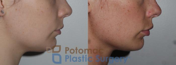 Before & After Lip Augmentation Case 149 Right Side View in Washington, DC