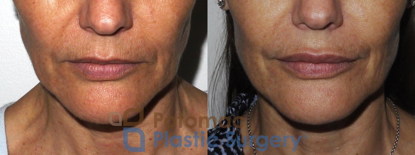 Before & After Lip Augmentation Case 158 Front View in Washington, DC