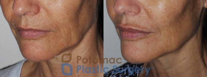 Before & After Botox Cosmetic Case 158 Left Oblique View in Washington DC & Arlington , DC