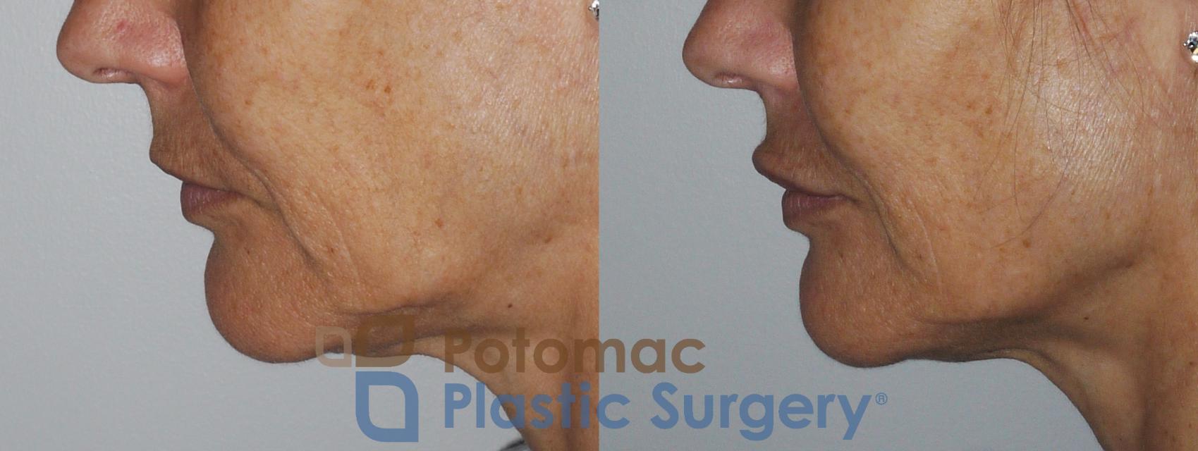 Before & After Lip Augmentation Case 158 Left Side View in Washington, DC