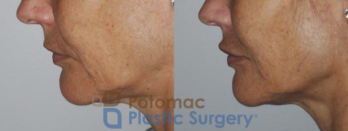 Before & After Botox Cosmetic Case 158 Left Side View in Washington DC & Arlington , DC