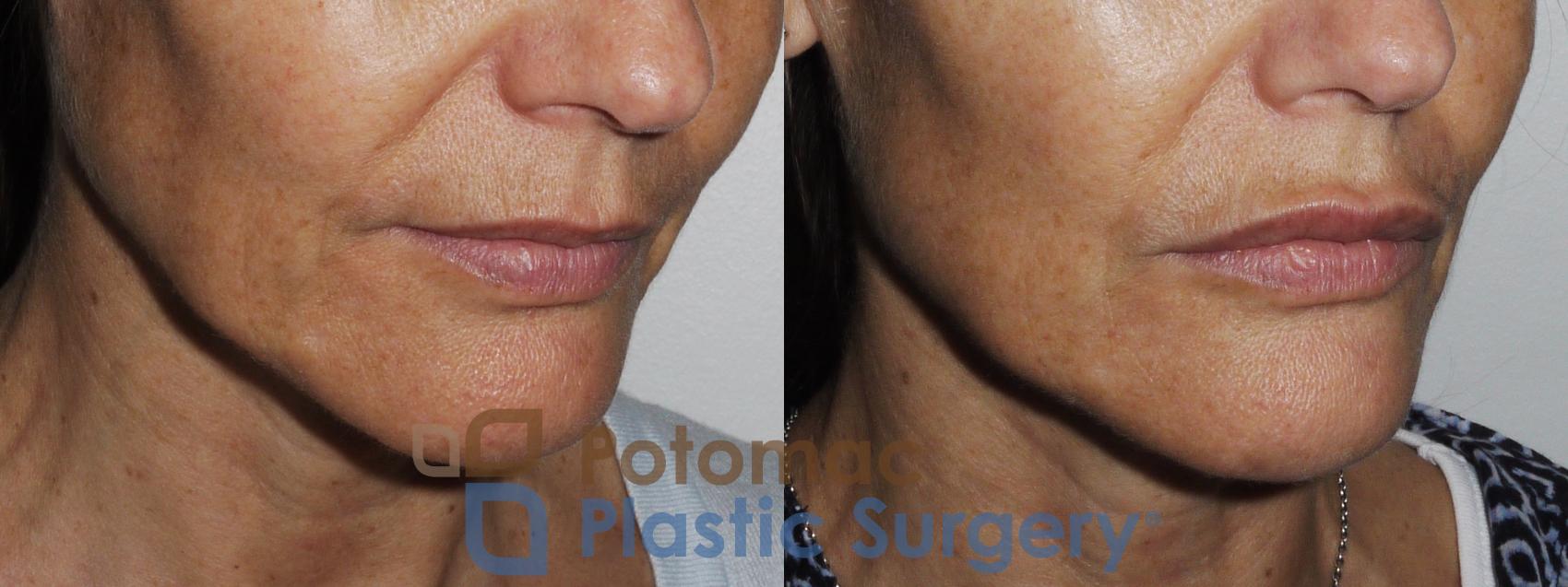 Before & After Dermal Fillers Case 158 Right Oblique View in Washington, DC