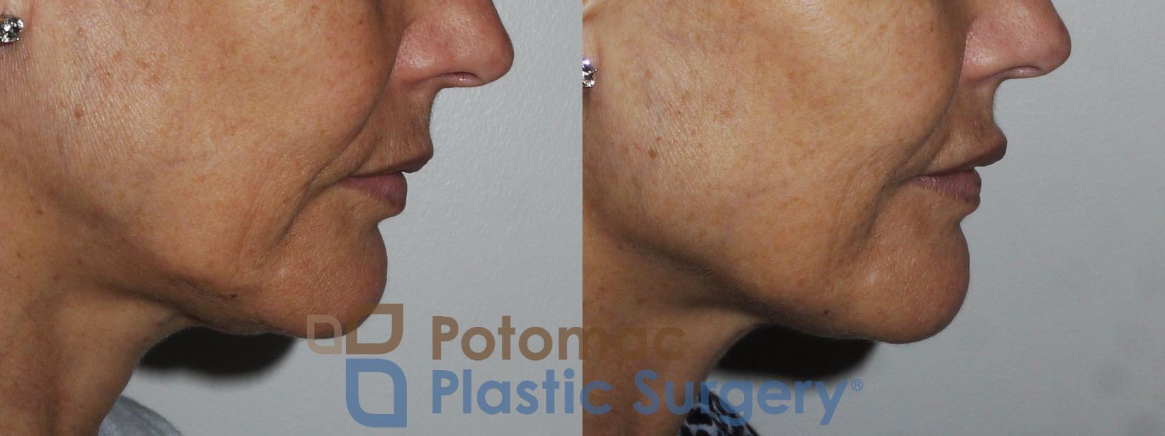 Before & After Dermal Fillers Case 158 Right Side View in Washington, DC