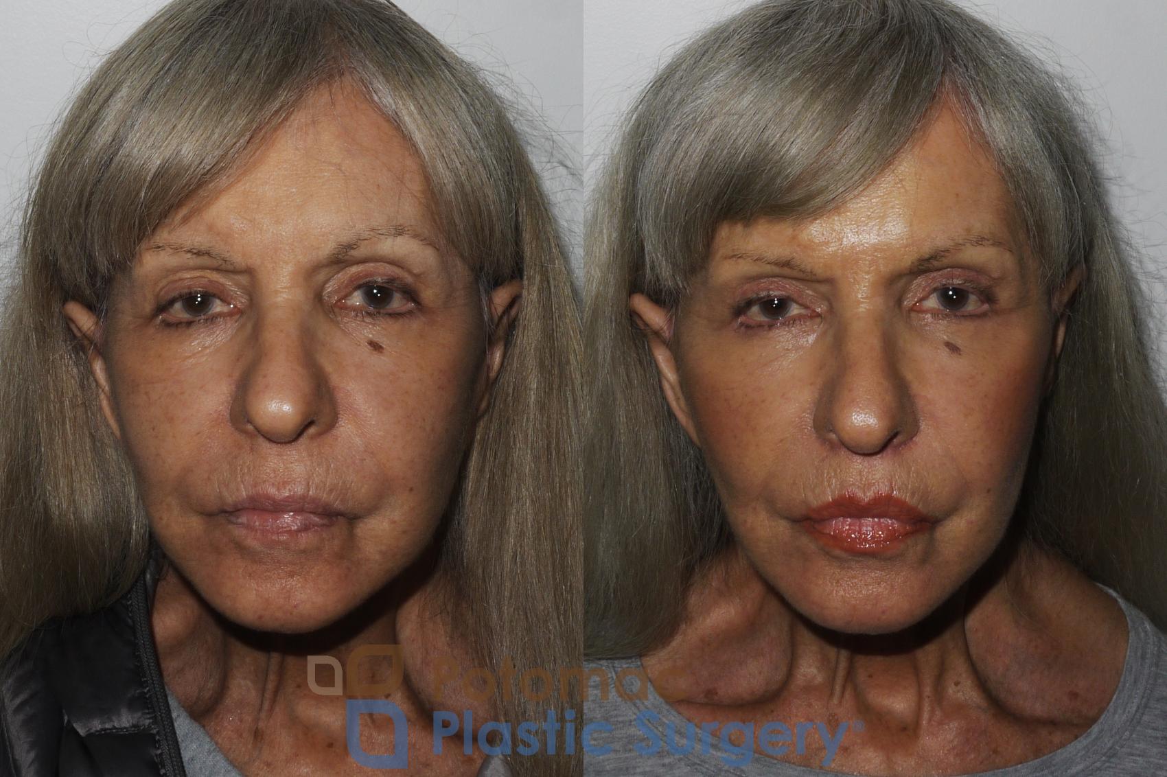 Before & After Lip Augmentation Case 174 Front View in Washington DC & Arlington , DC