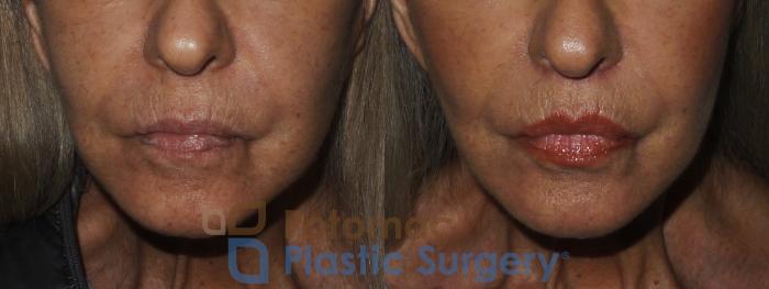 Before & After Lip Augmentation Case 174 Front View Close-Up #1 View in Washington DC & Arlington , DC