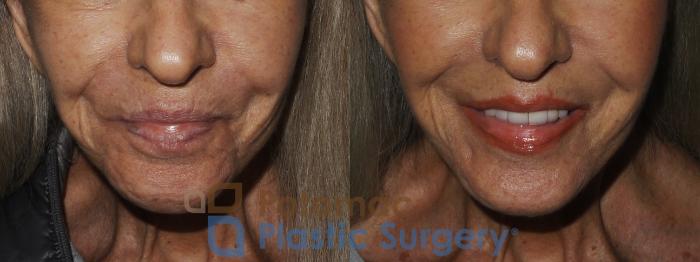 Before & After Lip Augmentation Case 174 Front View Close-Up #2 View in Washington DC & Arlington , DC