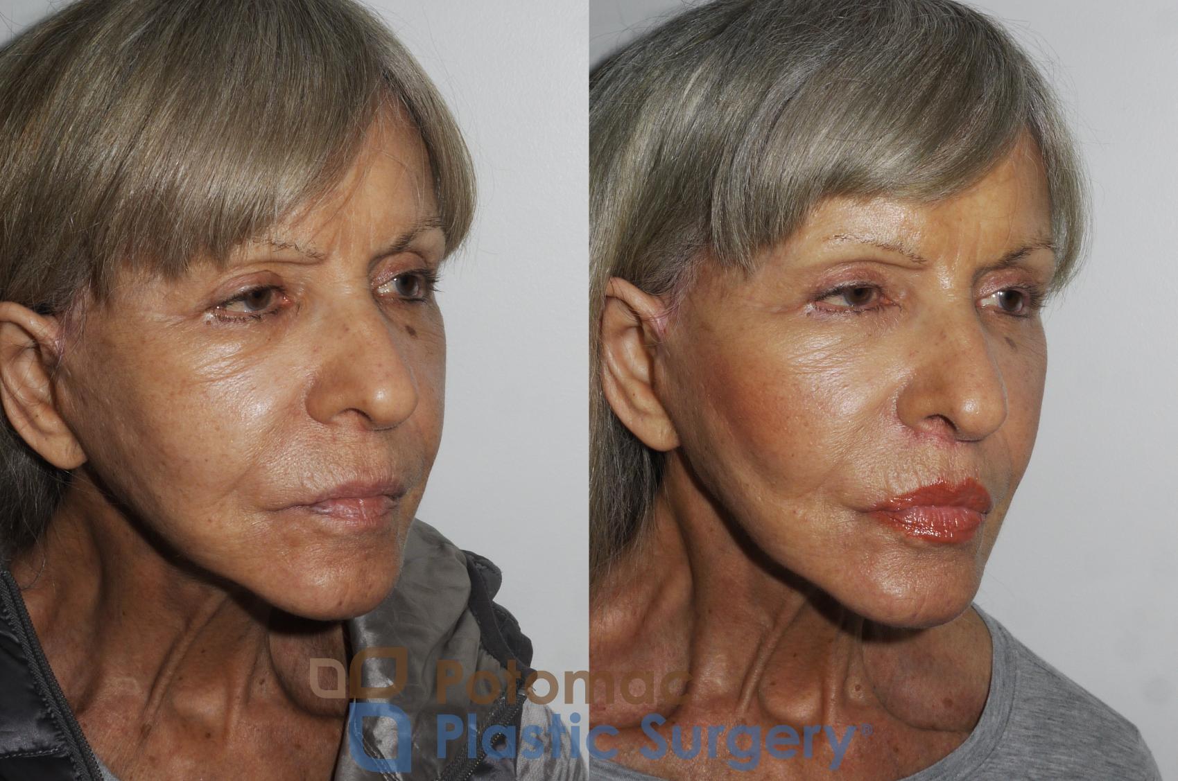Before & After Lip Augmentation Case 174 Right Oblique View in Washington, DC