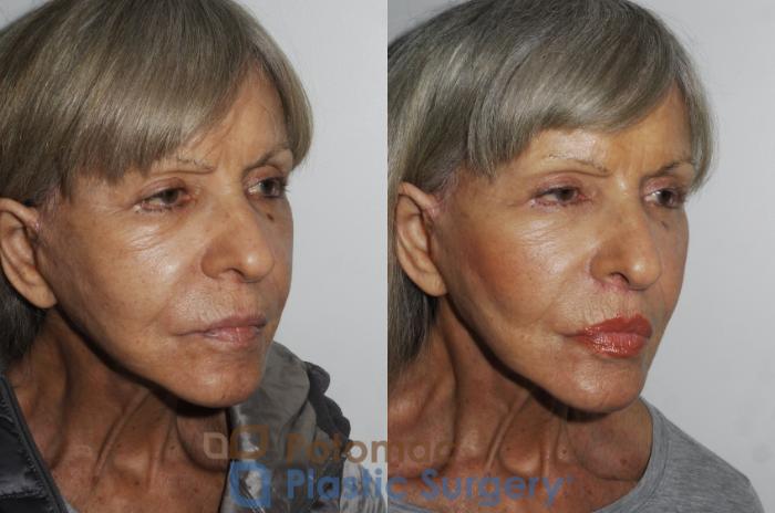 Before & After Lip Augmentation Case 174 Right Oblique View in Washington DC & Arlington , DC