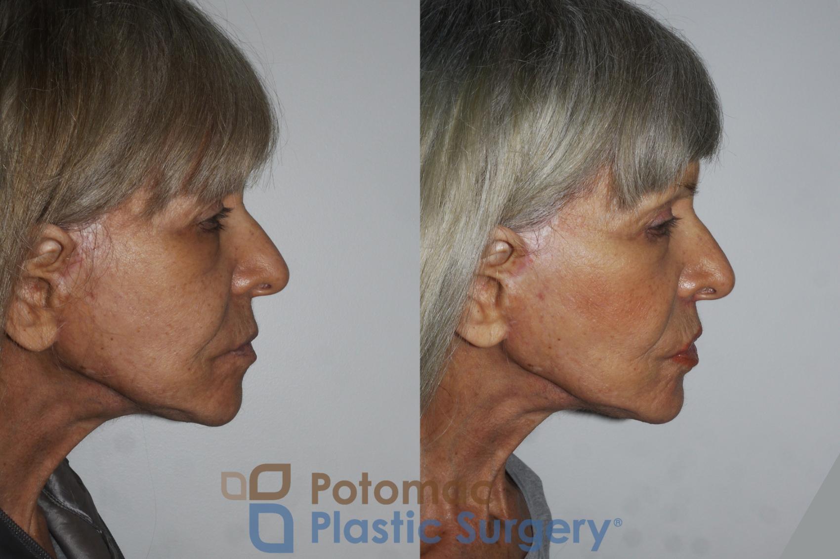Before & After Lip Augmentation Case 174 Right Side View in Washington, DC