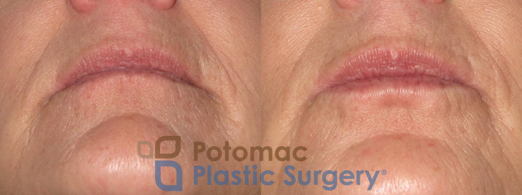 Before & After Lip Augmentation Case 18 Bottom View in Washington DC & Arlington , DC