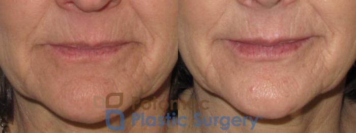 Before & After Dermal Fillers Case 18 Front View in Washington DC & Arlington , DC