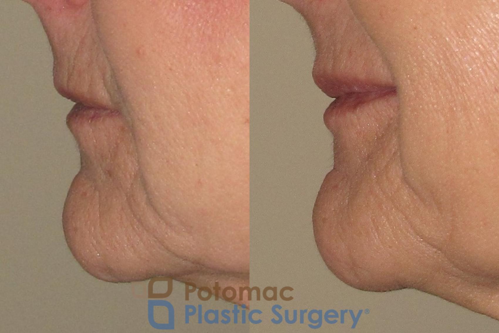 Before & After Lip Augmentation Case 18 Left Side View in Washington DC & Arlington , DC