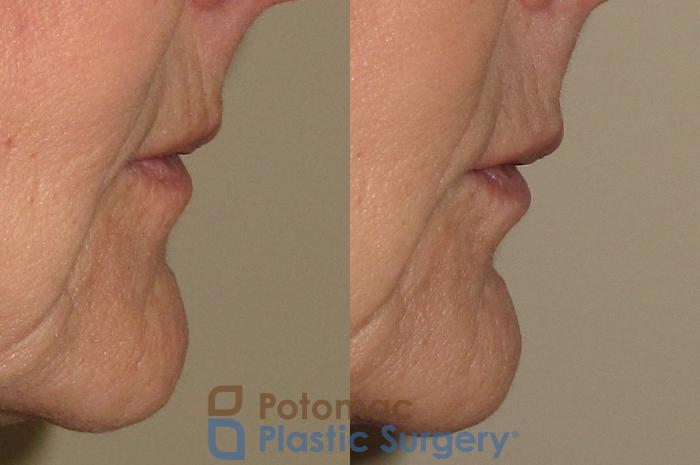 Before & After Lip Augmentation Case 18 Right Side View in Washington DC & Arlington , DC