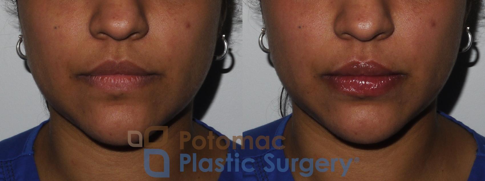 Before & After Lip Augmentation Case 210 Front View in Washington DC & Arlington , DC