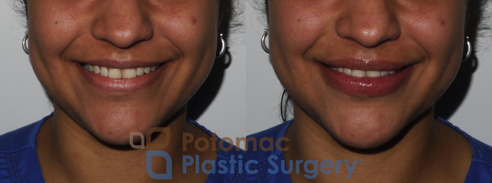 Before & After Lip Augmentation Case 210 Front View #2 View in Washington, DC