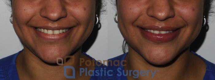 Before & After Dermal Fillers Case 210 Front View #2 View in Washington DC & Arlington , DC