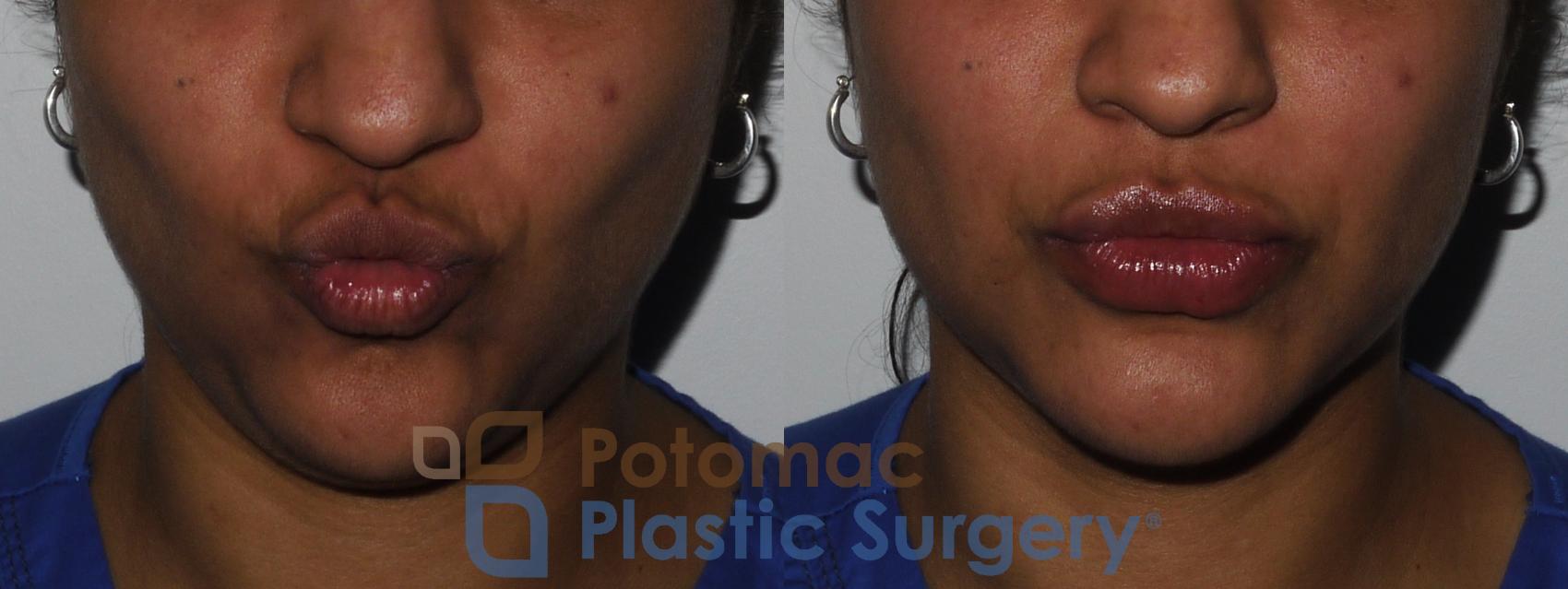 Before & After Lip Augmentation Case 210 Front View #3 View in Washington, DC