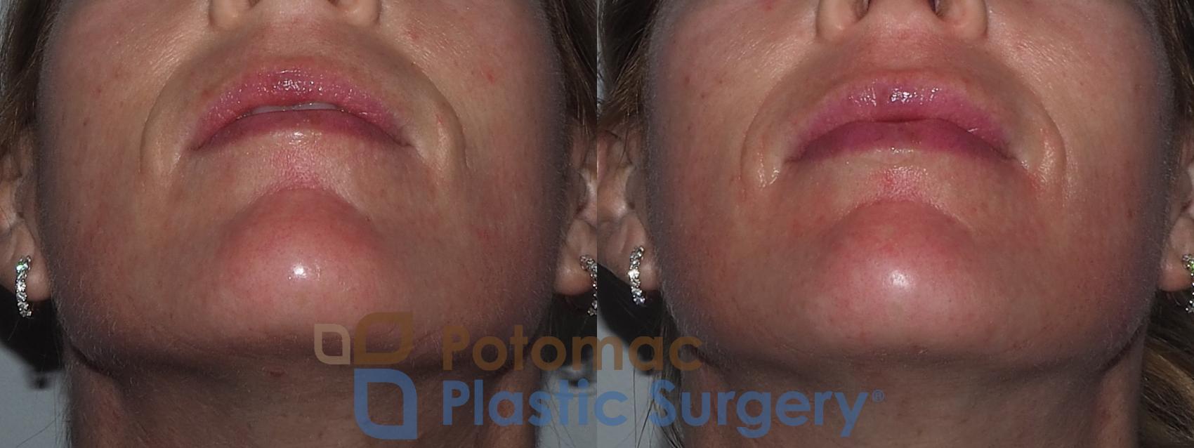 Before & After Lip Augmentation Case 211 Bottom View in Washington, DC