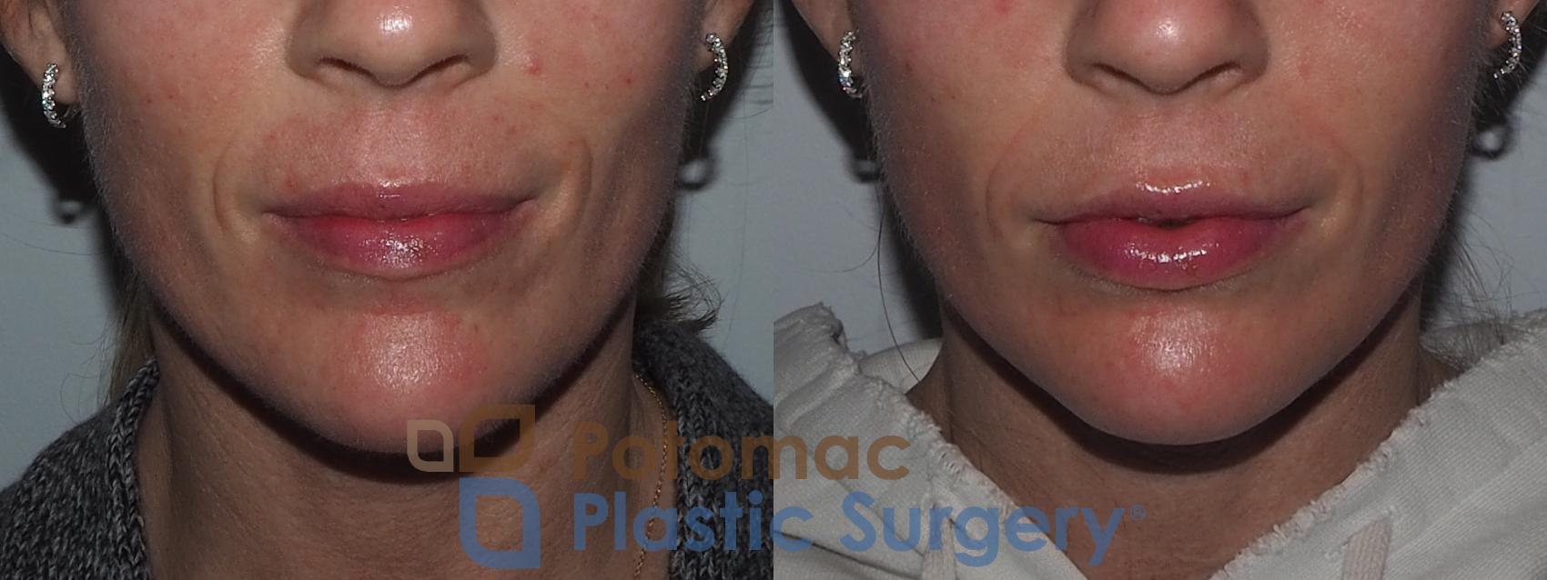 Before & After Lip Augmentation Case 211 Front View #1 View in Washington, DC