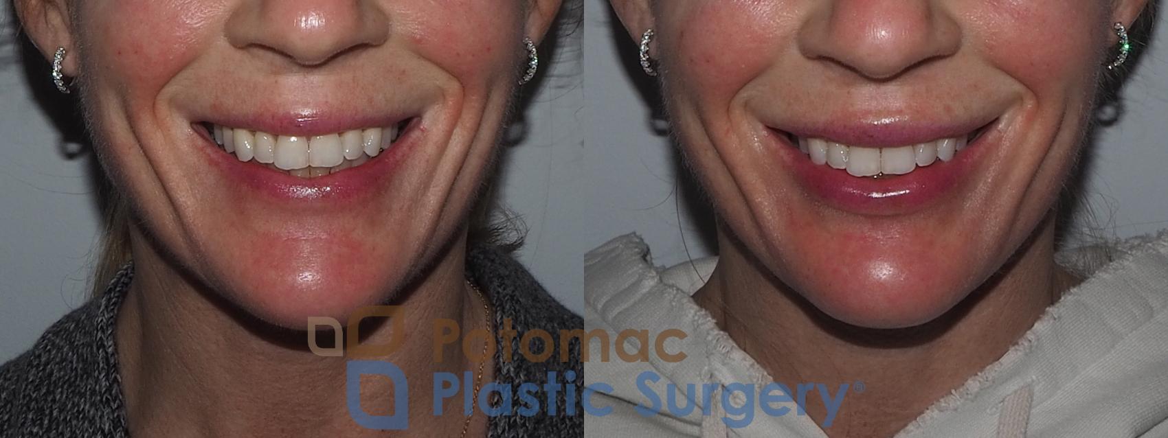 Before & After Lip Augmentation Case 211 Front View #2 View in Washington, DC