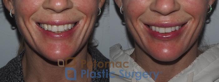 Before & After Dermal Fillers Case 211 Front View #2 View in Washington DC & Arlington , DC
