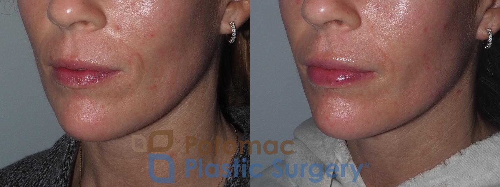 Before & After Lip Augmentation Case 211 Left Oblique View in Washington, DC