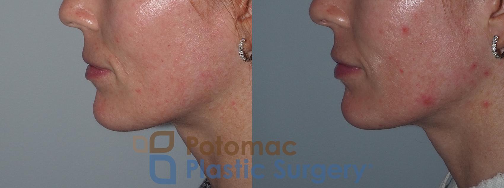 Before & After Lip Augmentation Case 211 Left Side View in Washington, DC