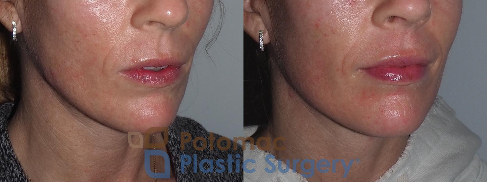 Before & After Lip Augmentation Case 211 Right Oblique View in Washington, DC