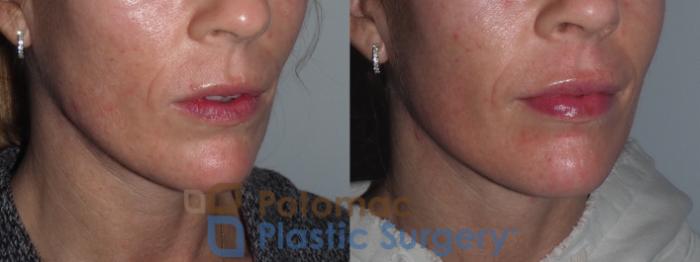Before & After Lip Augmentation Case 211 Right Oblique View in Washington DC & Arlington , DC