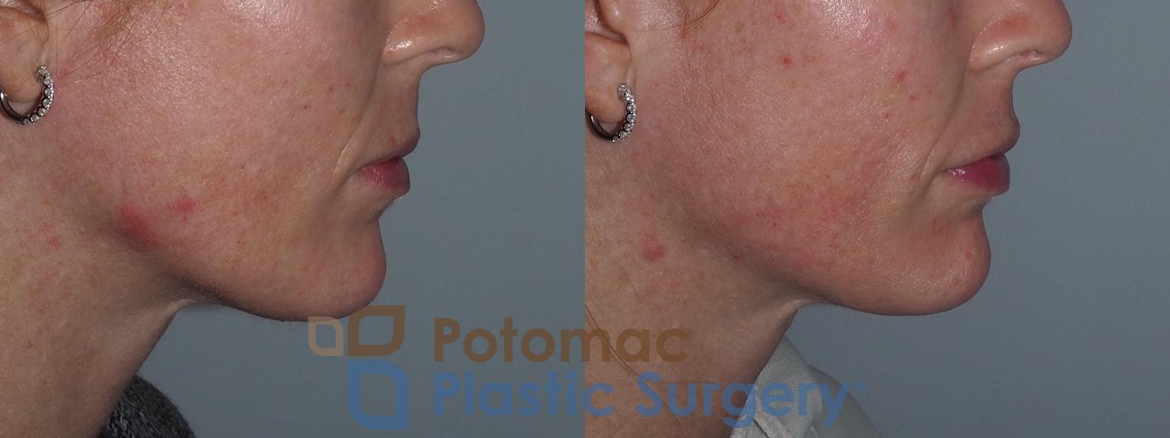 Before & After Lip Augmentation Case 211 Right Side View in Washington, DC