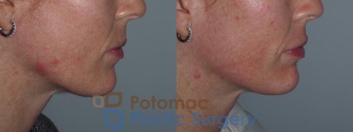 Before & After Dermal Fillers Case 211 Right Side View in Washington DC & Arlington , DC