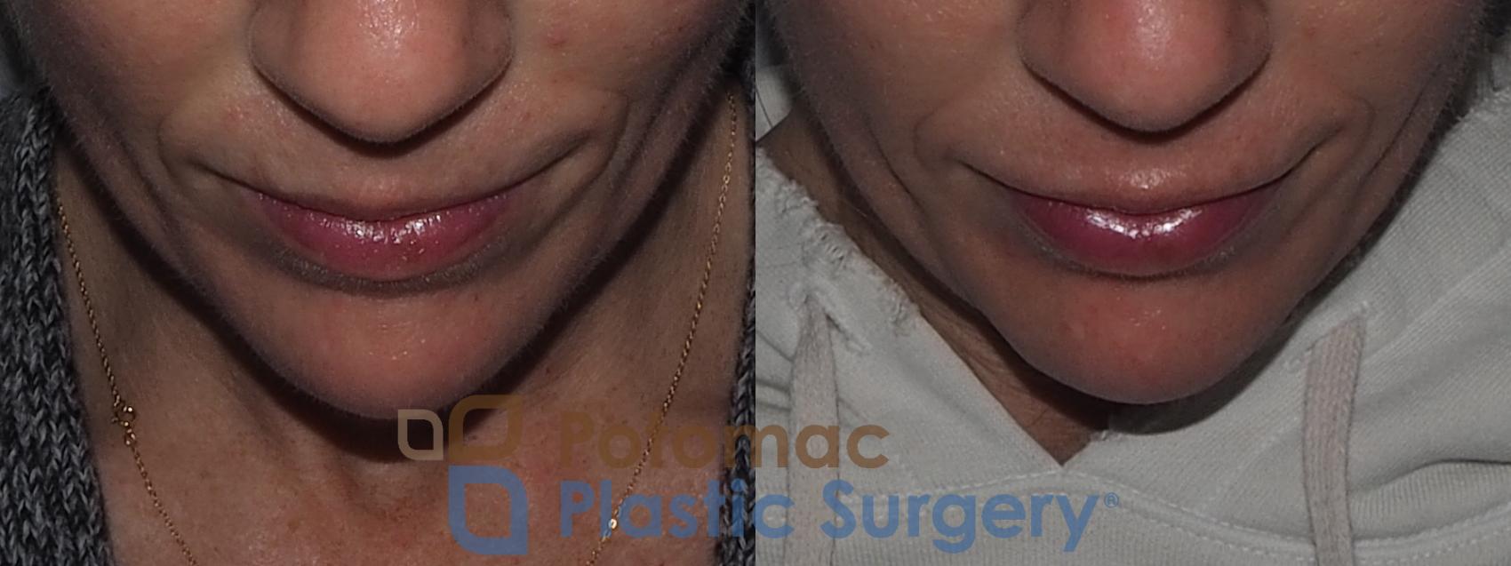 Before & After Lip Augmentation Case 211 Top View in Washington, DC
