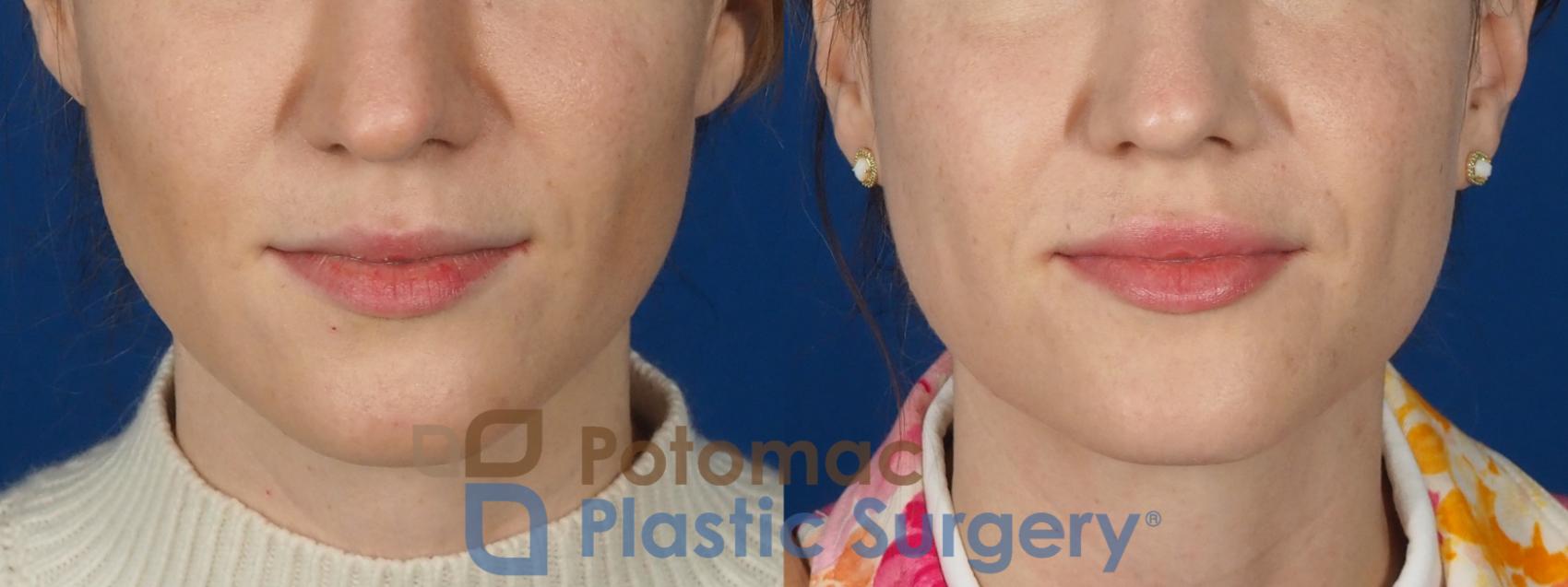 Before & After Lip Augmentation Case 282 Front View in Washington, DC
