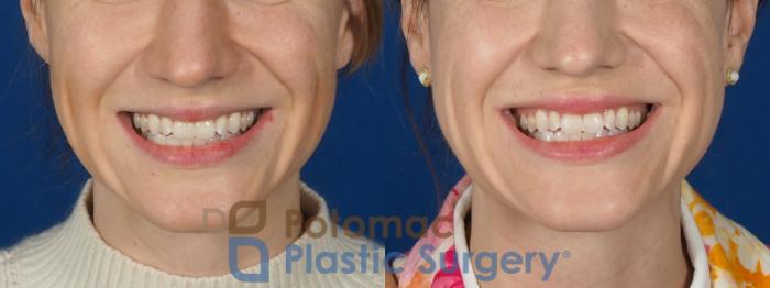 Before & After Lip Augmentation Case 282 Front - Smiling View in Washington DC & Arlington , DC