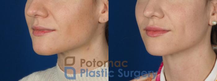 Before & After Lip Augmentation Case 282 Left Oblique View in Washington DC & Arlington , DC
