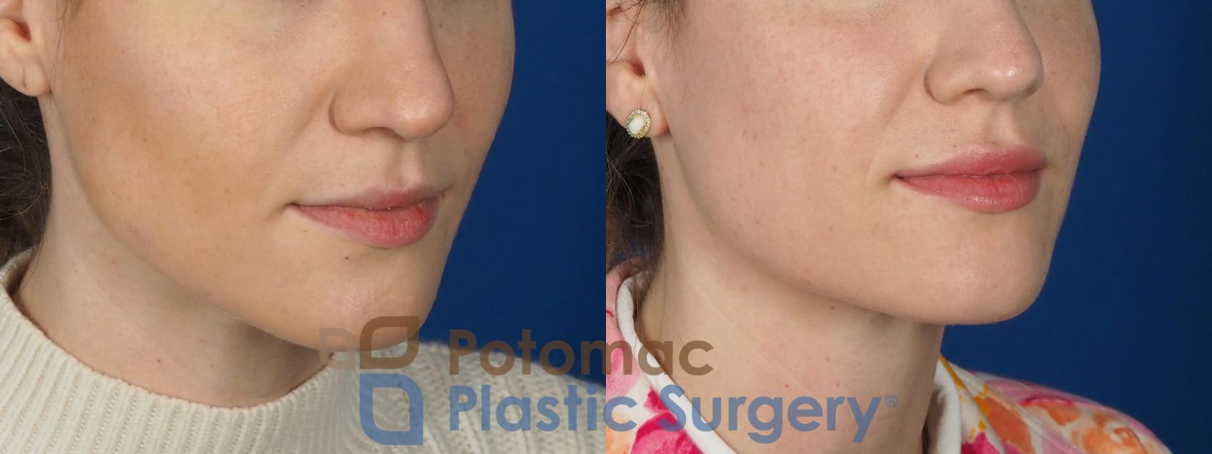 Before & After Lip Augmentation Case 282 Right Oblique View in Washington, DC