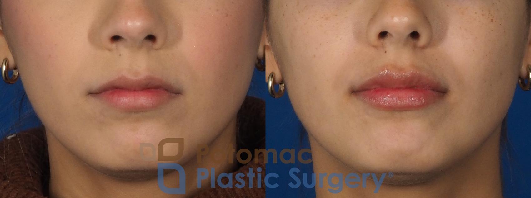 Before & After Lip Augmentation Case 306 Front View in Washington, DC