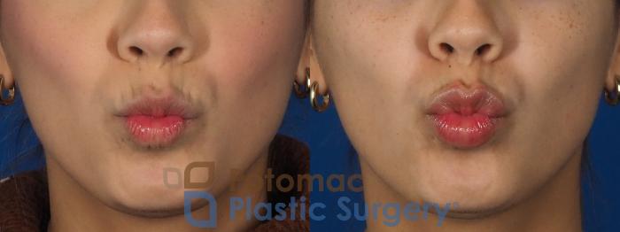 Before & After Dermal Fillers Case 306 Front - Kissing View in Washington DC & Arlington , DC