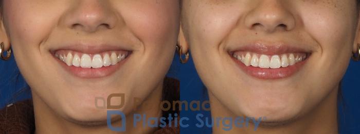 Before & After Lip Augmentation Case 306 Front - Smiling View in Washington DC & Arlington , DC