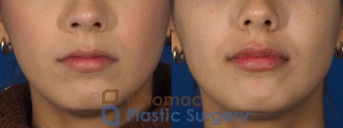 Before & After Dermal Fillers Case 306 Front View in Washington DC & Arlington , DC